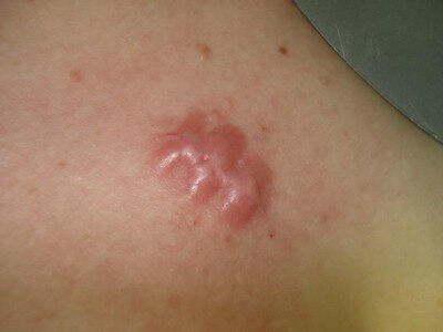 Гипертрофический рубец3 Гипертрофический рубец3