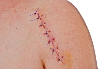 Чем лечить шрамы после операции
