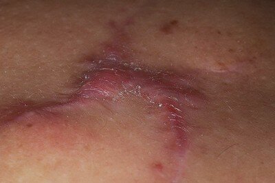 Келоид Келоид