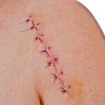 Процесс заживления и возникающие осложнения при лечении рубцов после операции