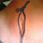 Наиболее действенные способы устранения шрамов после операции