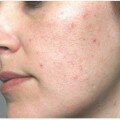 Домашние и аптечные болтушки против прыщей Прыщи на лице