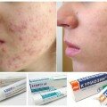 Как правильно выбрать крем от прыщей на лице Различные кремы от прыщей