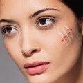 Несколько способов, как убрать шрамы на лице