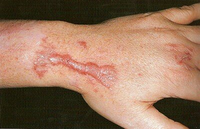 Шрам на руке Шрам на руке