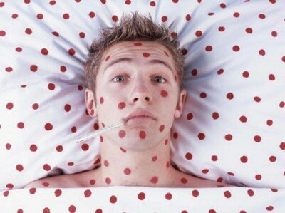 Заболевание ветрянкой Заболевание ветрянкой