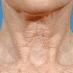 Что поможет убрать морщины на вашей шее