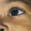 Папилломы вокруг глаза у ребенка