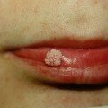 Вся правда о лечении вируса папилломы человека Папиллома на губах