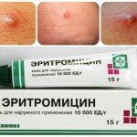 Как действует эритромициновая мазь от прыщей