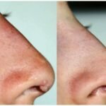 Появление бородавки на носу – сигнал для борьбы с вирусом